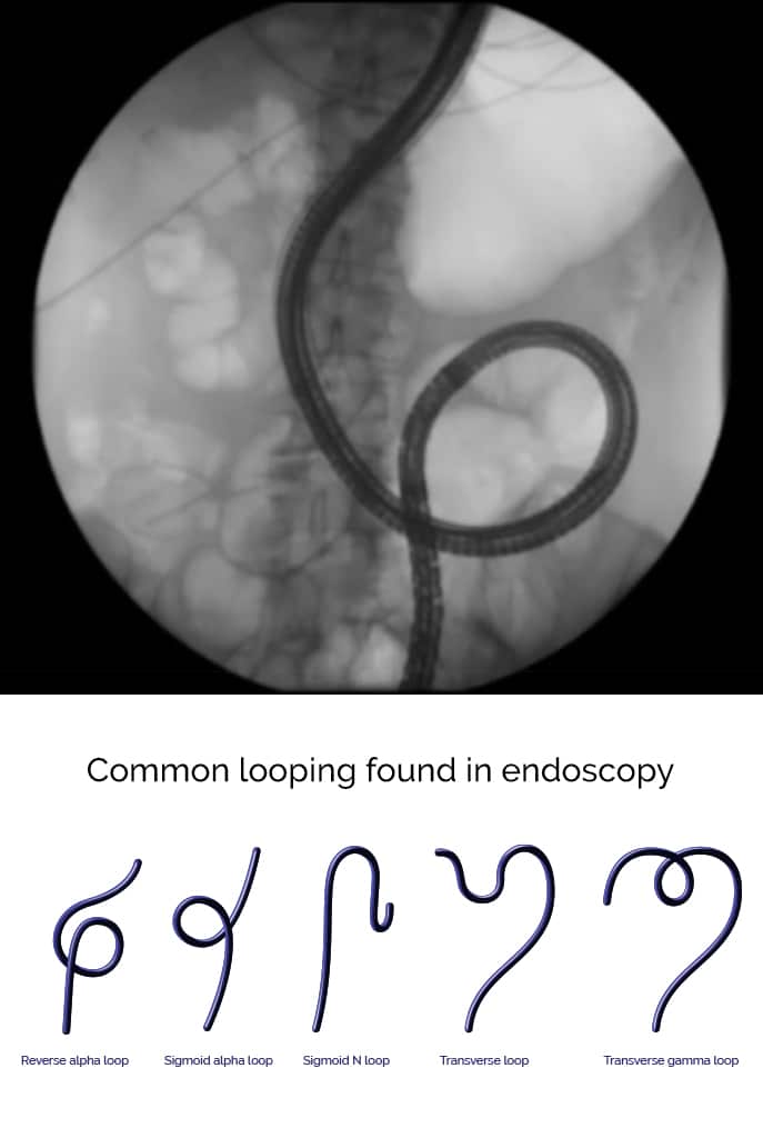 common looping found in endoscopy