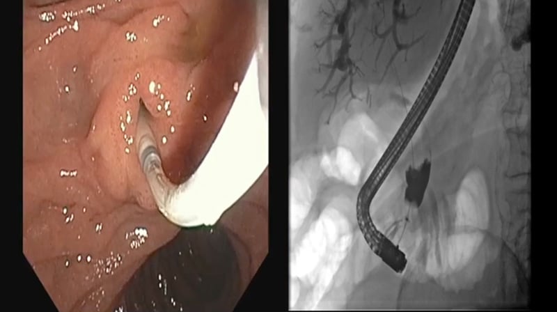 intraductal papillary mucinous neoplasm video